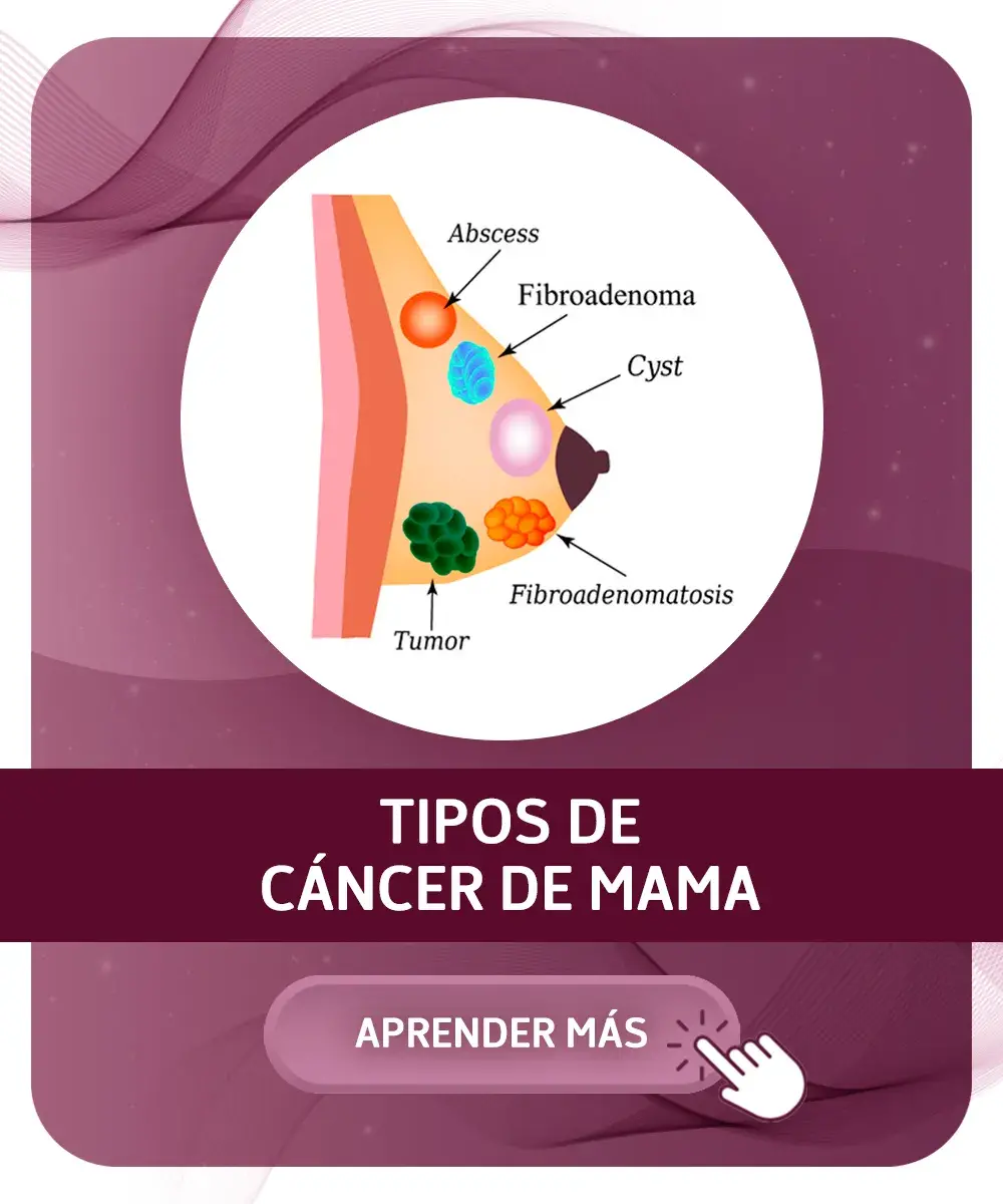 Enlace a tipos de cáncer de mama