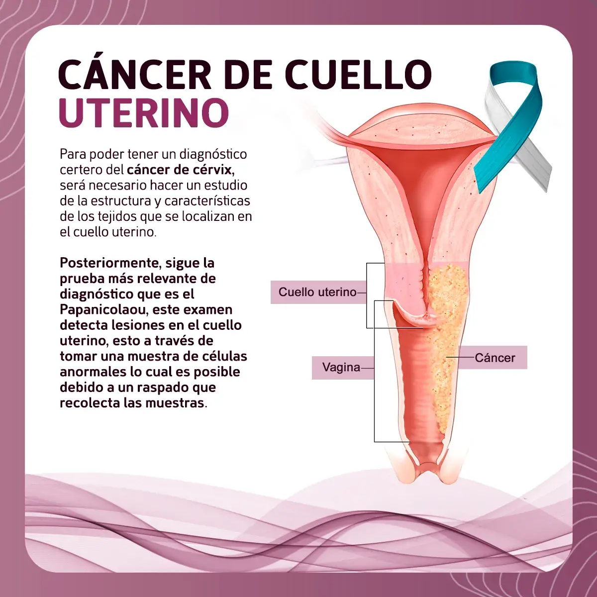 La detección del cáncer de cérvix se hace mediante la toma de muestra de células