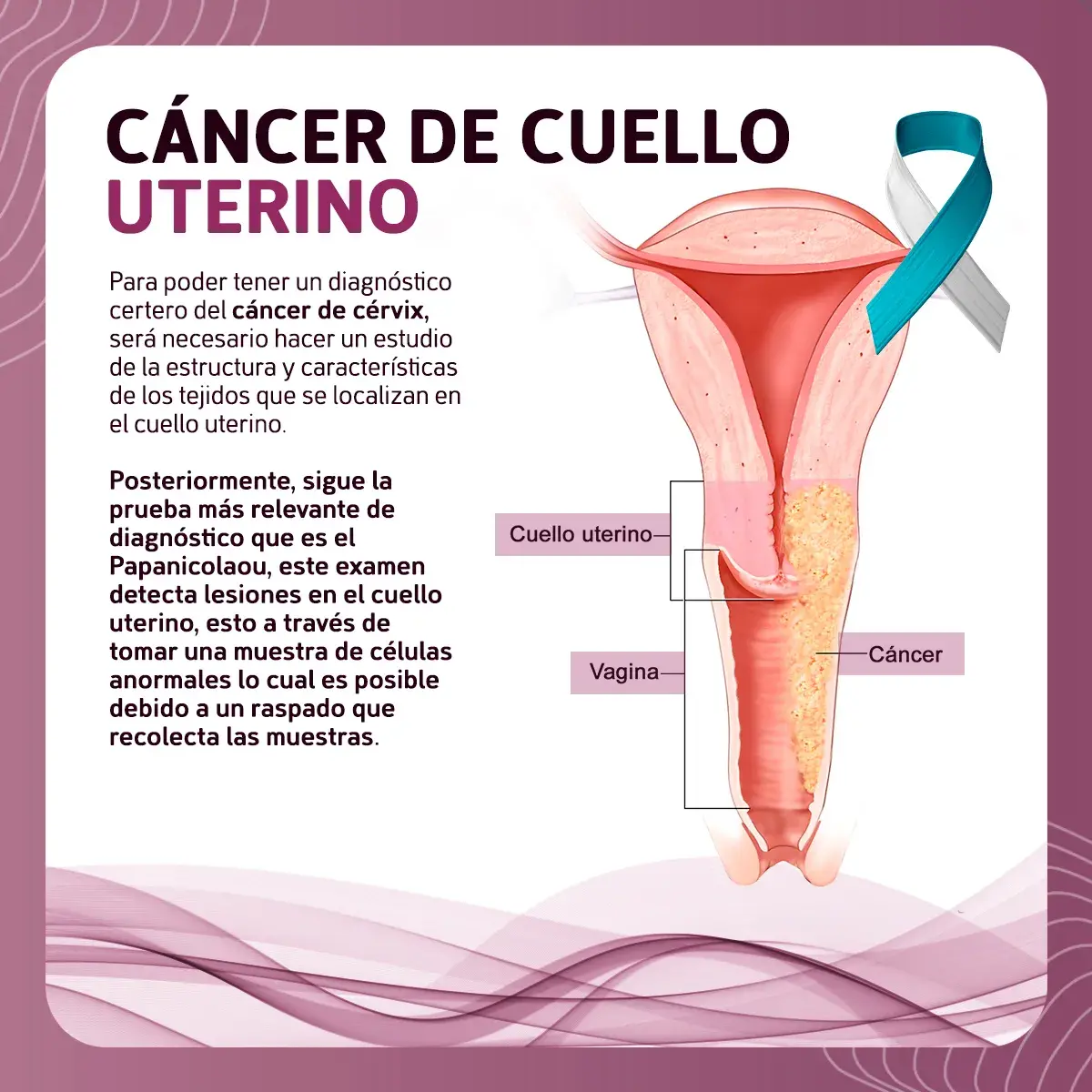 Cáncer De Cérvix Información Para Pacientes