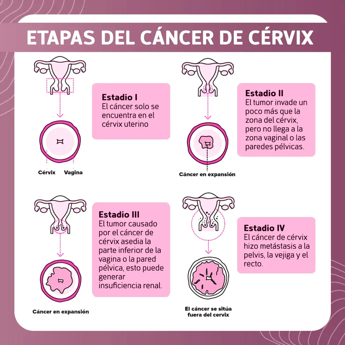 Etapas cáncer de cérvix (estadio I, II, III, IV)