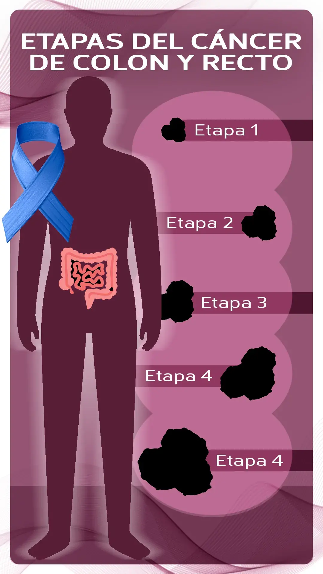 etapas del cáncer de colon y recto ( etapa 1, etapa 2, etapa 3, etapa 4).