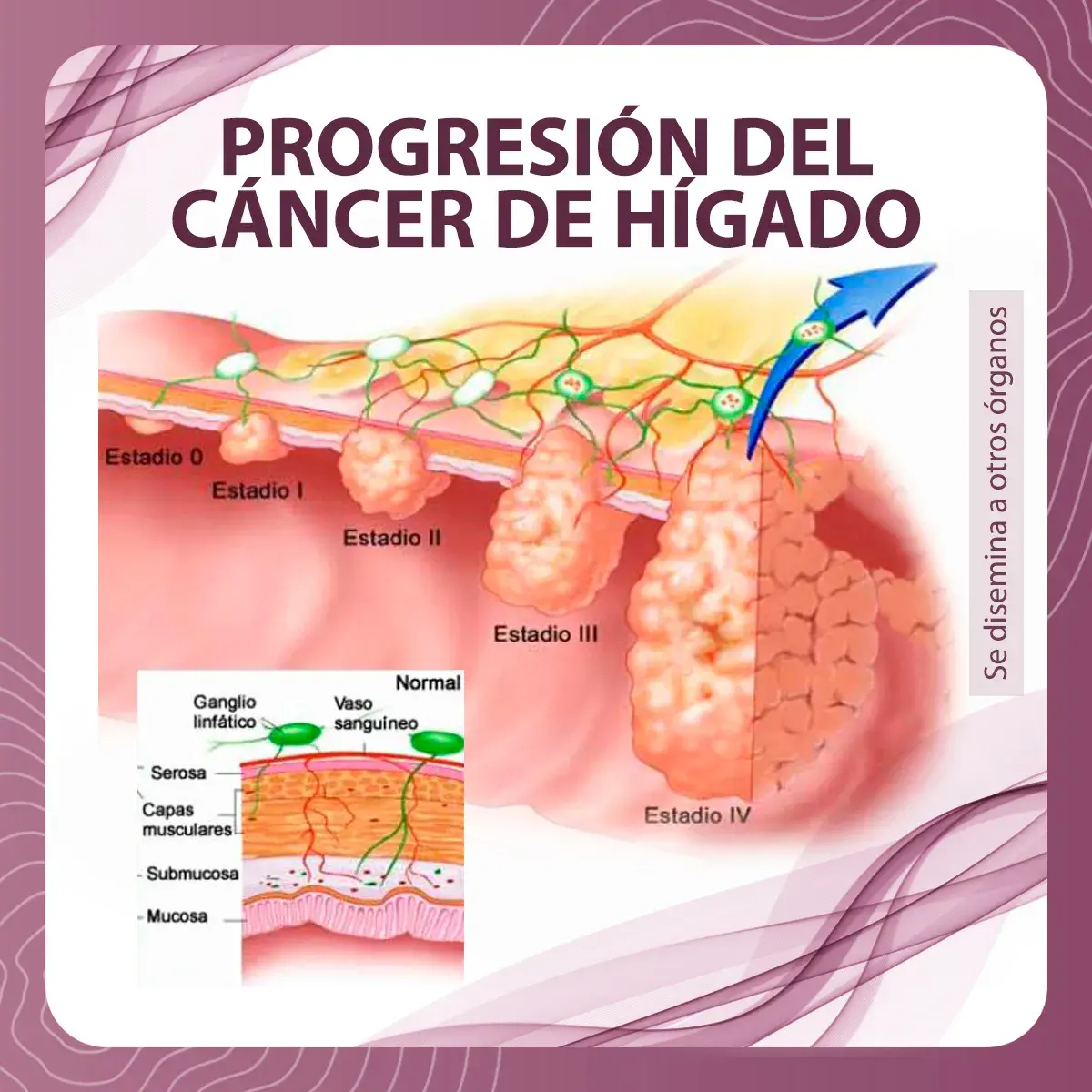 Progresión de los estadios del cáncer de hígado. (Estadio 0, I, II, III, IV)