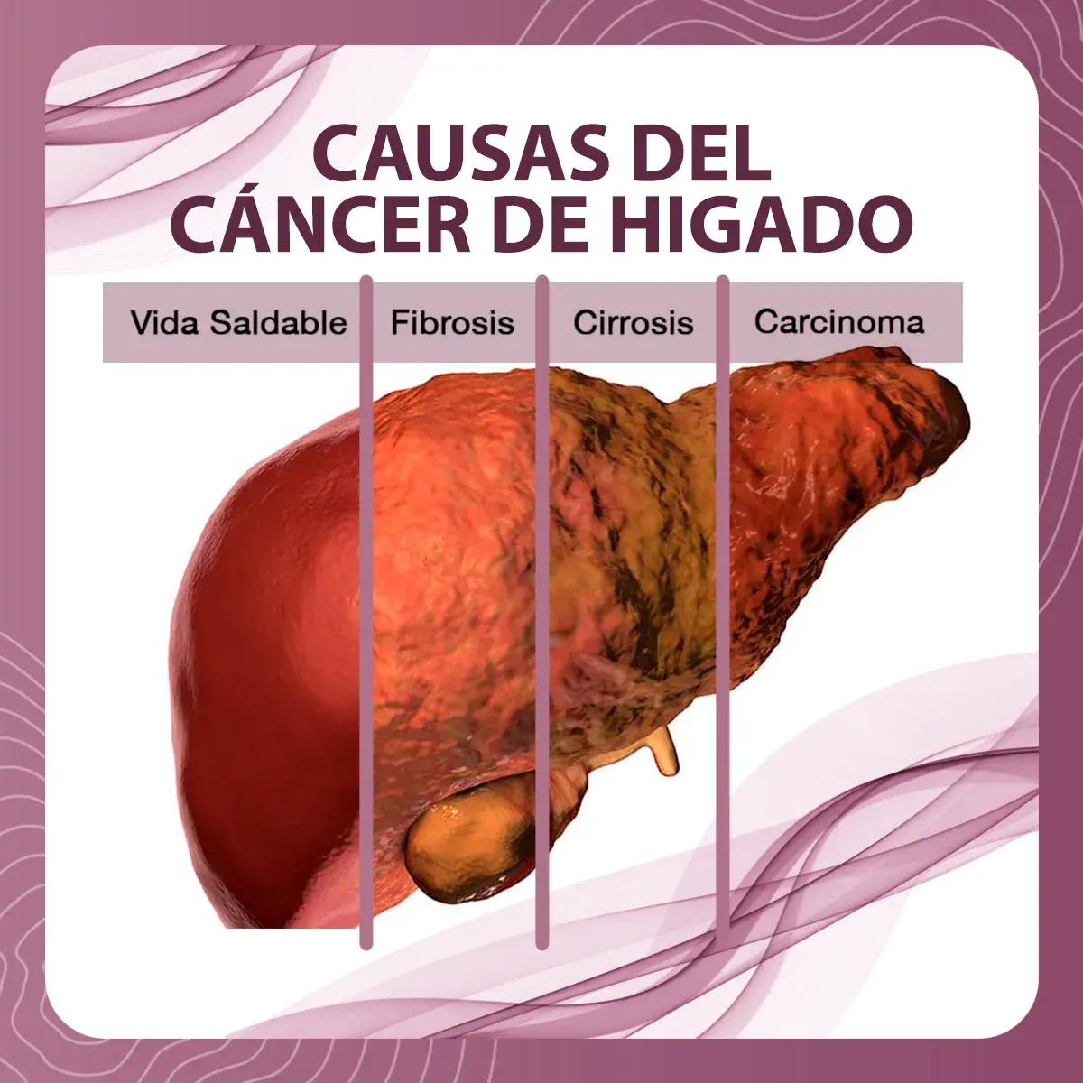 El cáncer de hígado pasa por un desarrollo en el cual primero el órgano está sano, posteriormente pasa por la fibrosis, cirrosis y al final el carcinoma