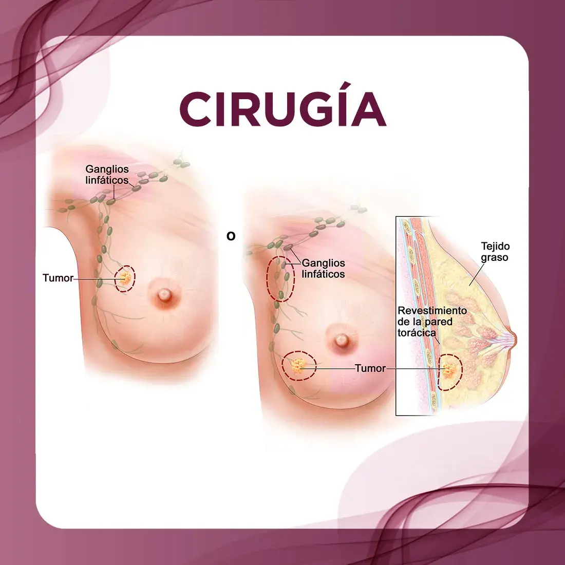 Cirugía, tratamiento para el cáncer de mama