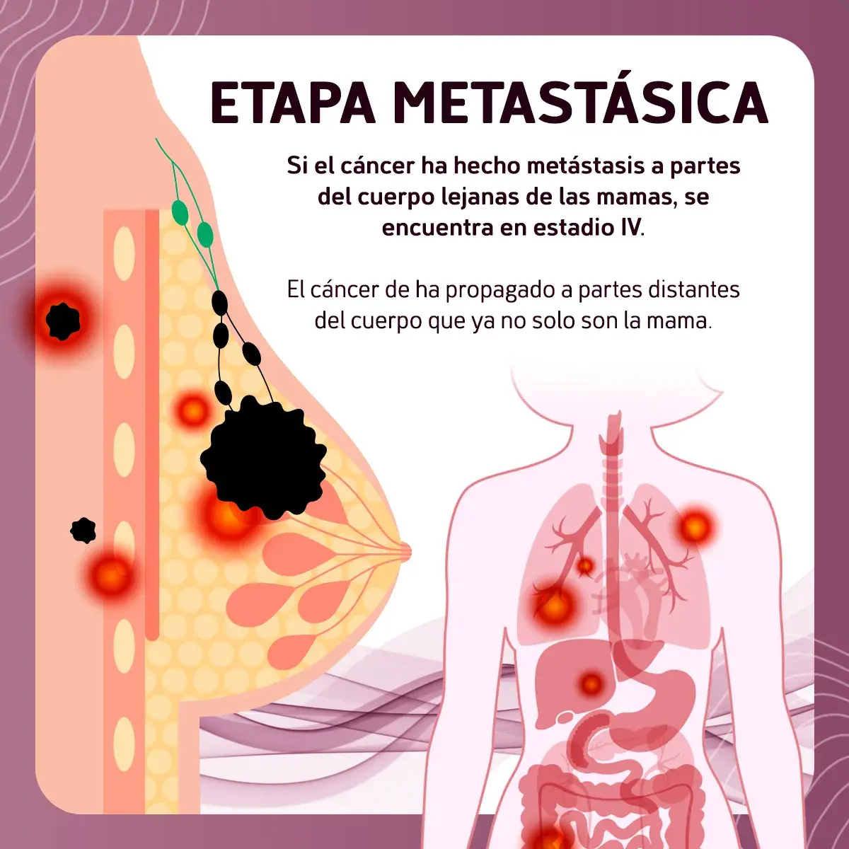 El cáncer de mama puede evolucionar a una etapa metastásica