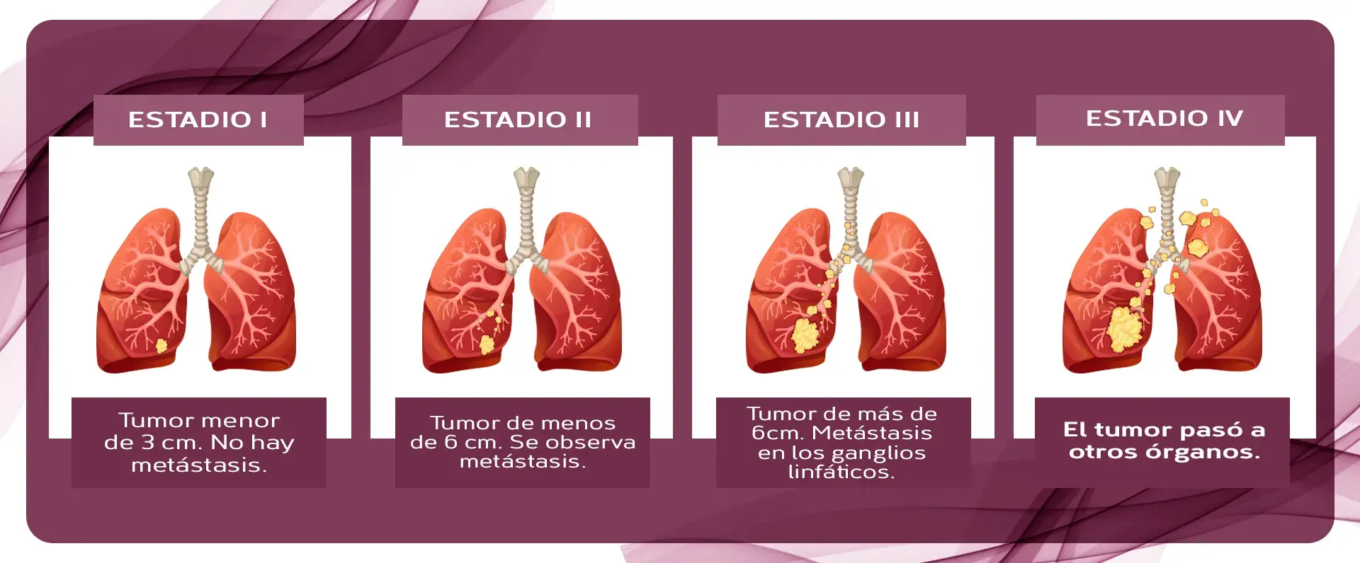Estadio del cáncer de pulmón (Estadio I, II, III, IV)