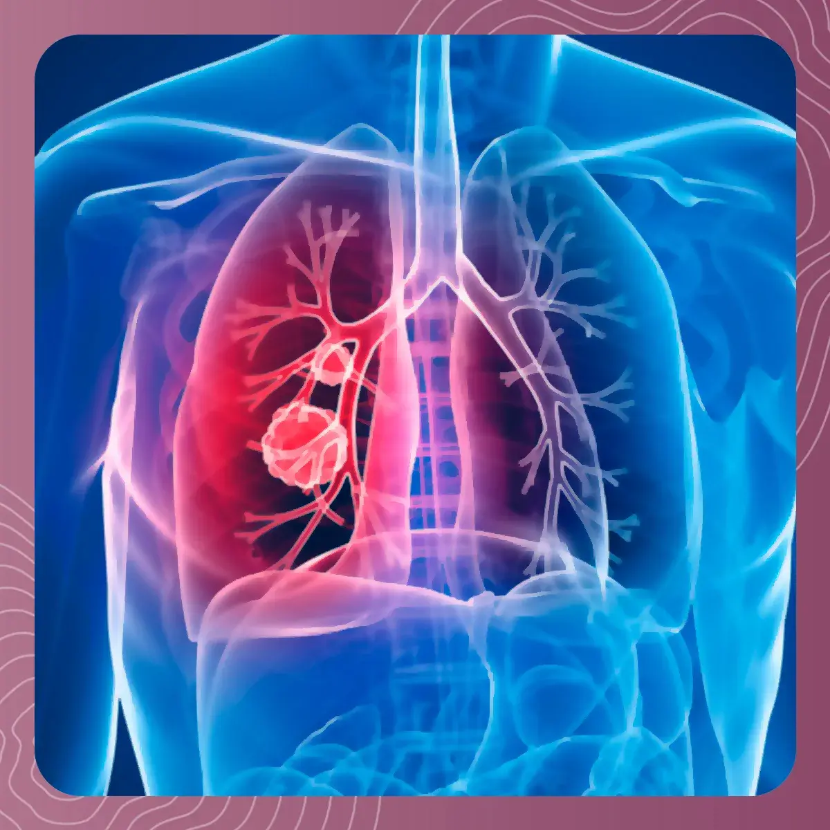Tumor localizado en la cavidad pulmonar que se genera por el cáncer de pulmón