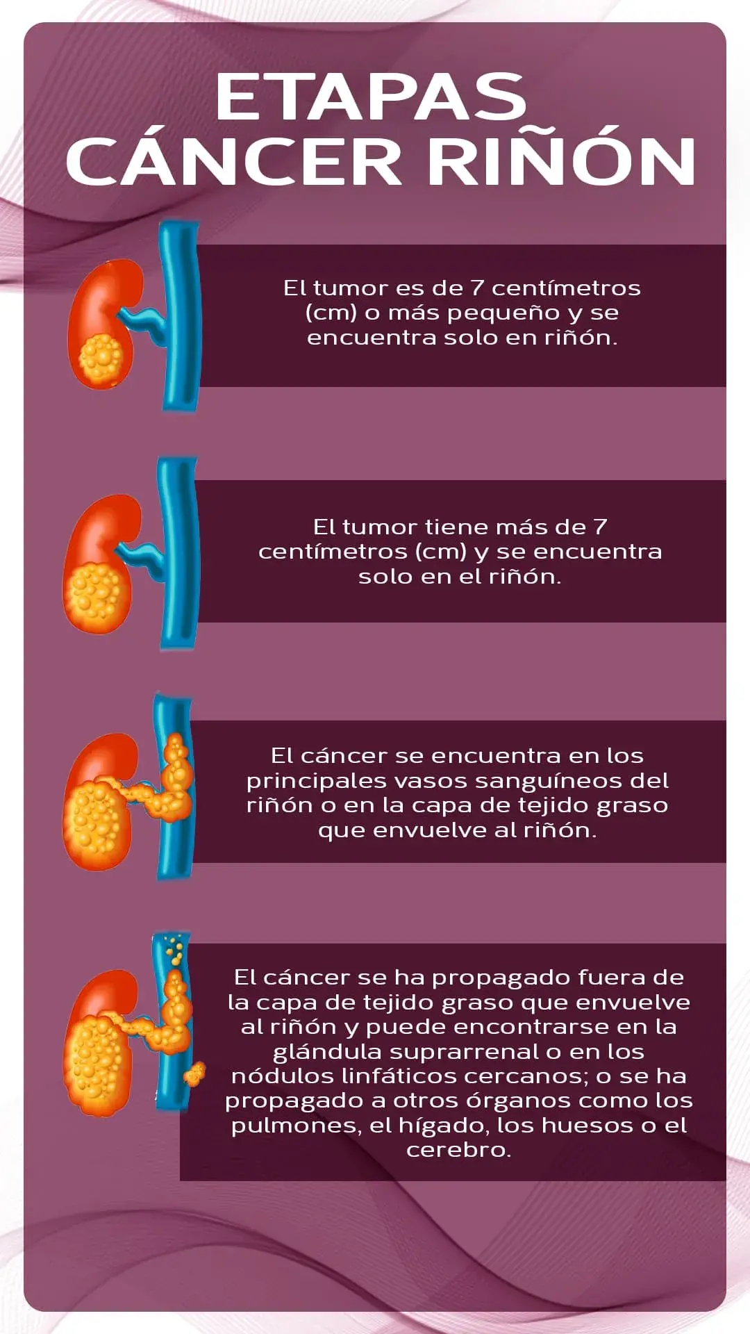 Las etapas del cáncer de riñon (I,II, III, IV)