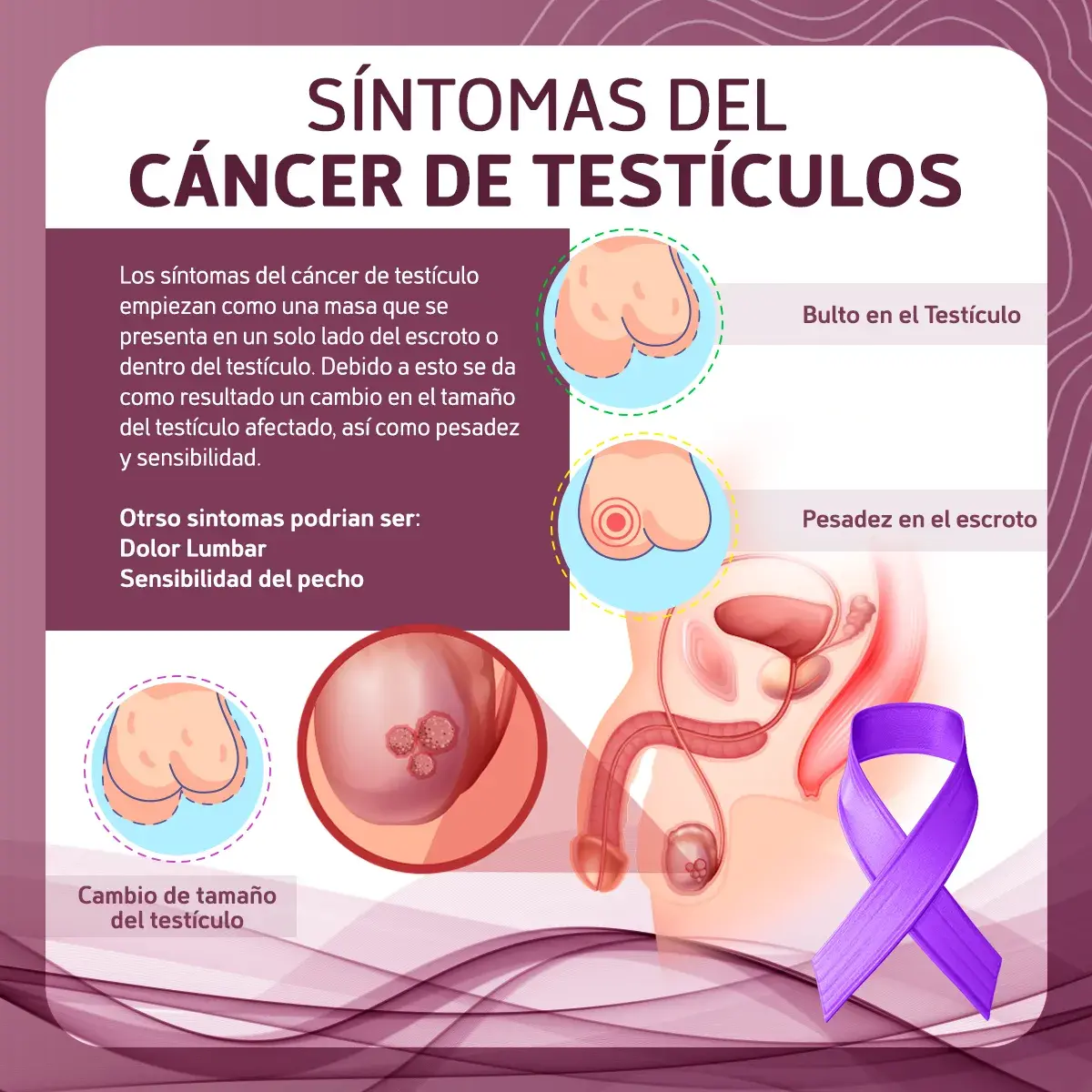 Síntomas del cáncer de testículos (bulto en el testículo, pesadez en el escroto, cambio de tamaño)