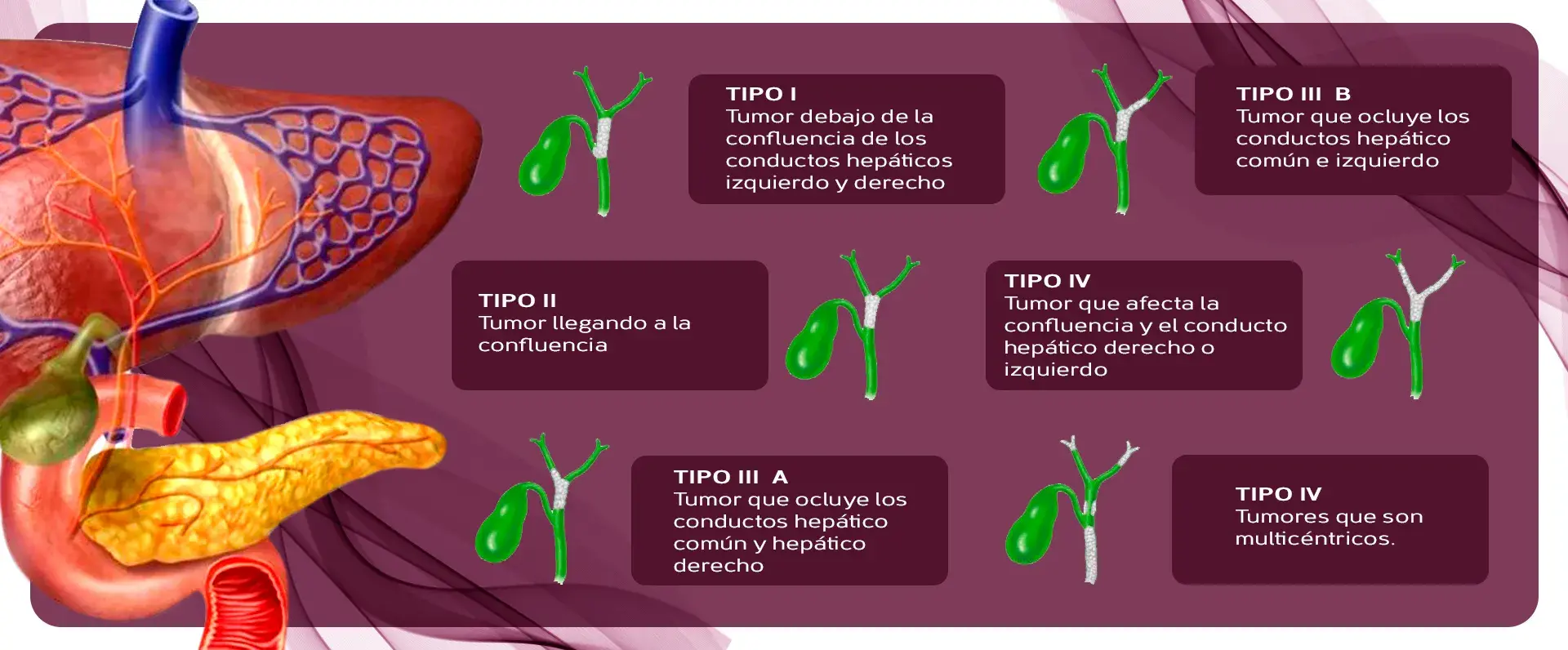 La clasificación del cáncer de vías biliares puede ser tipo I, tipo II, Tipo III A, IIIB, Tipo IV